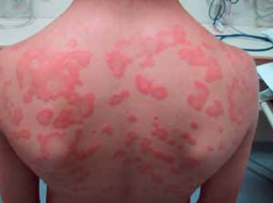 Allergic Reaction Hives All Over Body